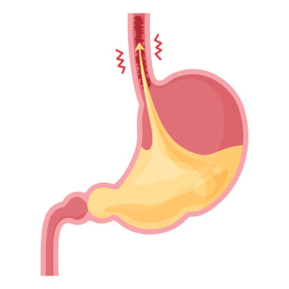 逆流性食道炎とは